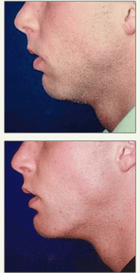 erkek yüz implantı