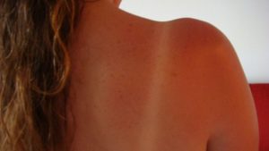 Güneş Yanığına Ne İyi Gelir? Acısı Nasıl Geçer? Krem Önerileri