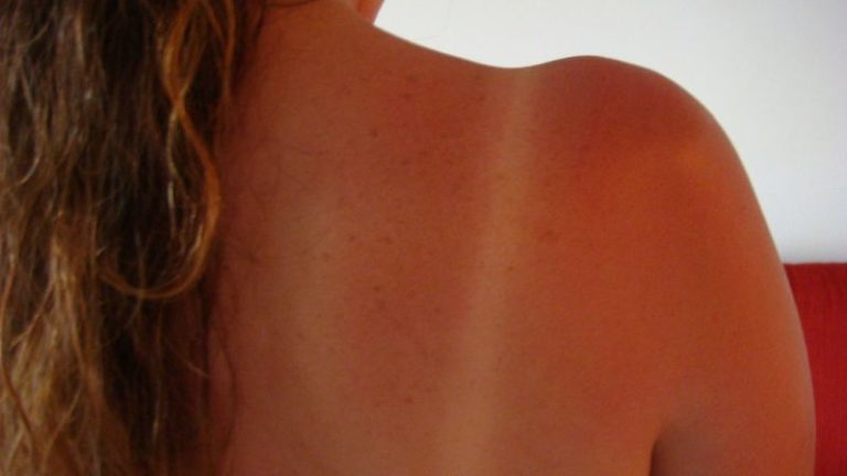 Güneş Yanığına Ne İyi Gelir? Acısı Nasıl Geçer? Krem Önerileri