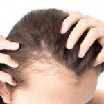 Kadınlarda Saç Dökülmesi Nasıl Önlenir? Nedenleri Tedavisi