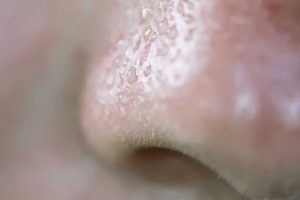 Burun Yağlanması Ve Siyah Nokta Nedenleri Nedir Nasıl Geçer?