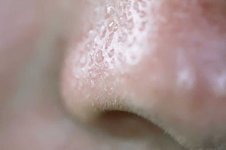 Burun Yağlanması Ve Siyah Nokta Nedenleri Nedir Nasıl Geçer?